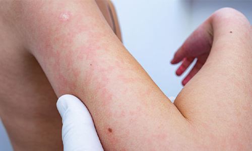 Autoimmune-Diseases
