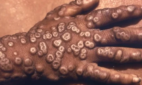  Early Modern Pandemics