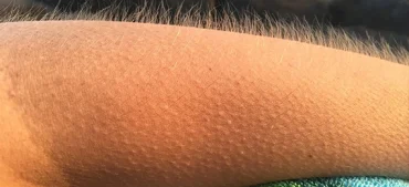 Why Do We Get Goosebumps? The Science Behind That Sudden Chill