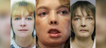 Who Got the World’s First Face Transplant?