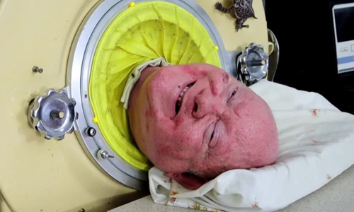 Who is the Last Person to Use an Iron Lung